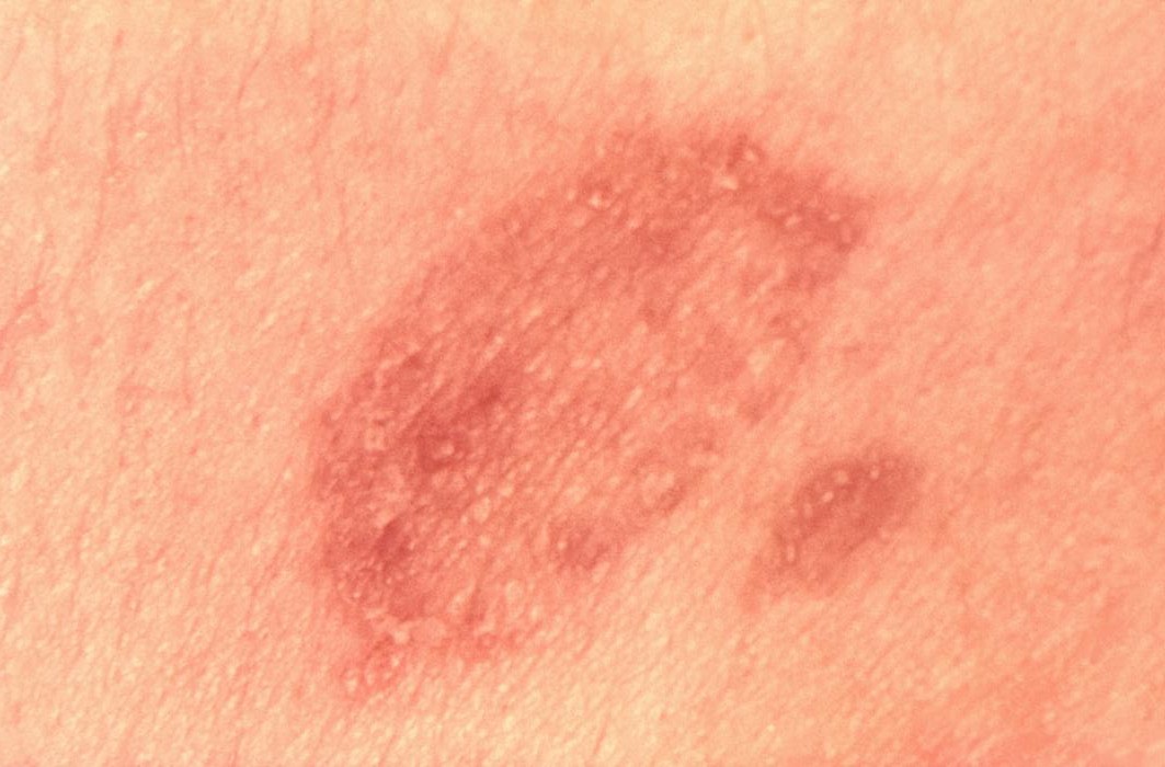 Ringworm Causes Psoriasis And It Is Contagious PsoriasisDietPlan